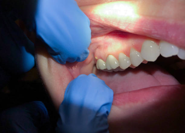 Best Emergency Dentist for Lost Fillings or Crowns in Wood Dale, IL