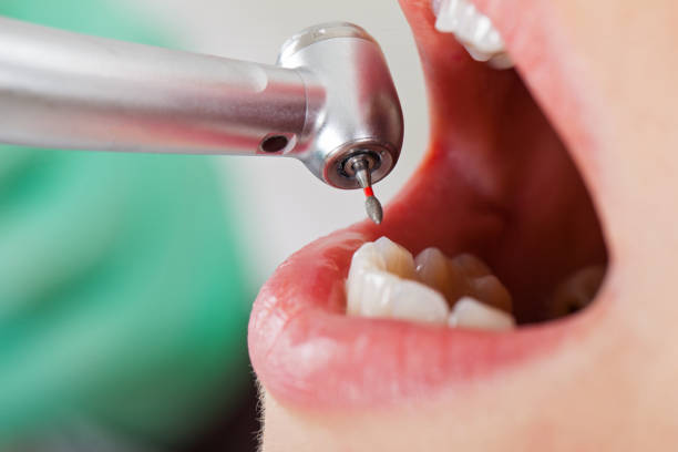 Best Emergency Dentist for Lost Fillings or Crowns in Wood Dale, IL